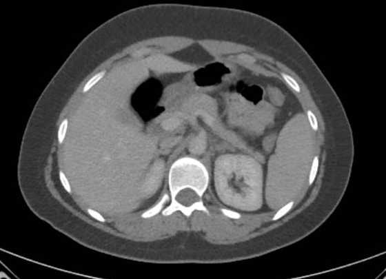 Acute unilateral nonhemorrhagic adrenal infarction (Radiopaedia 67560-76957 Axial renal parenchymal phase 38).jpg