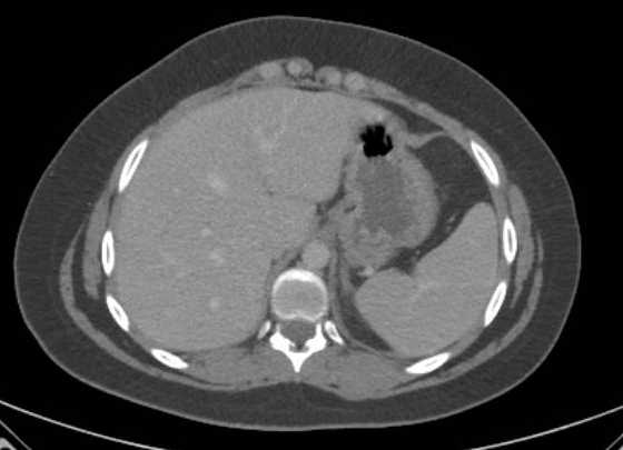 Acute unilateral nonhemorrhagic adrenal infarction (Radiopaedia 67560-76957 Axial renal parenchymal phase 7).jpg
