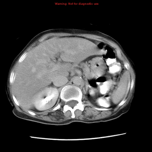 File:Adenocarcinoma of the colon (Radiopaedia 8191-9039 Axial renal excretory phase 9).jpg
