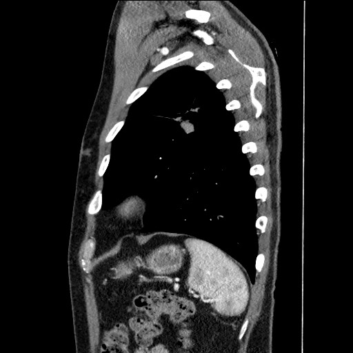 Adenocarcinoma of the lung (Radiopaedia 59871-67325 Sagittal C+ arterial phase 85).jpg