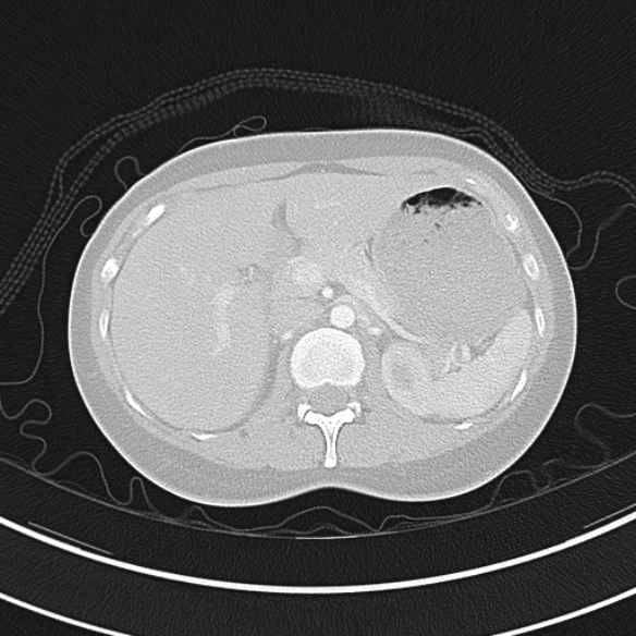 File:Adenocystic carcinoma of the trachea (Radiopaedia 47677-52525 Axial lung window 81).jpg