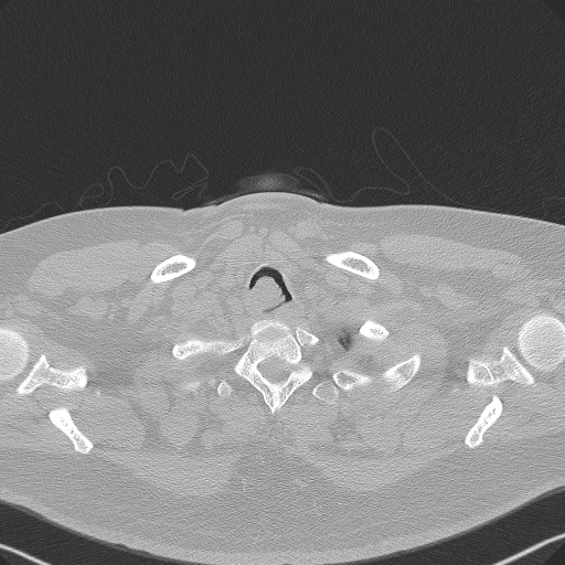 File:Adenoid cystic carcinoma of the trachea (Radiopaedia 49042-54137 Axial lung window 18).jpg