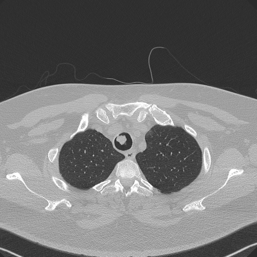 Adenoid cystic carcinoma of the trachea (Radiopaedia 49042-54137 Axial lung window 56).jpg