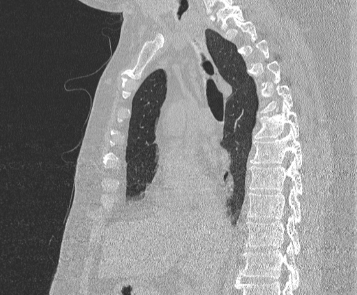 Adenoid cystic carcinoma of the trachea (Radiopaedia 49042-54137 Sagittal lung window 216).jpg