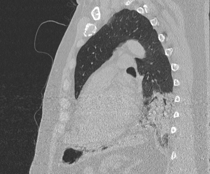 Adenoid cystic carcinoma of the trachea (Radiopaedia 49042-54137 Sagittal lung window 293).jpg
