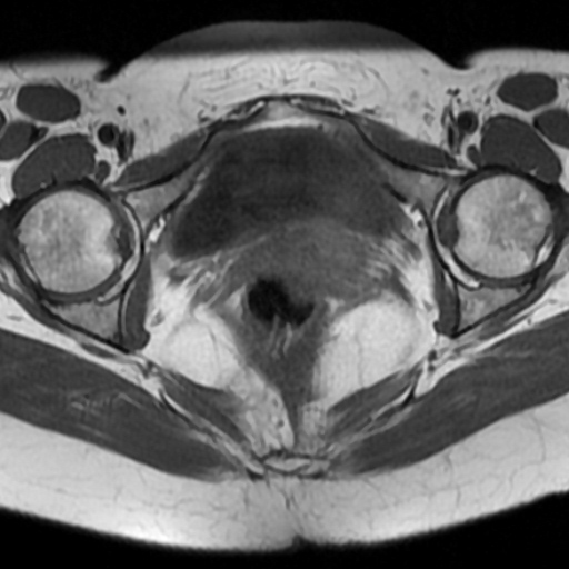 File:Adenoma malignum of cervix (Radiopaedia 66441-75705 Axial T1 13).jpg
