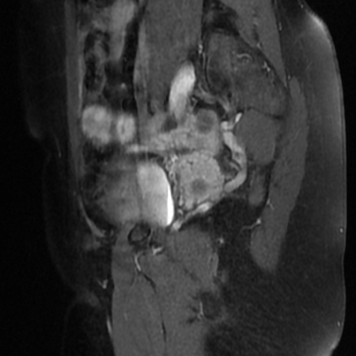 File:Adenoma malignum of cervix (Radiopaedia 66441-75705 Sagittal T1 C+ fat sat 19).jpg
