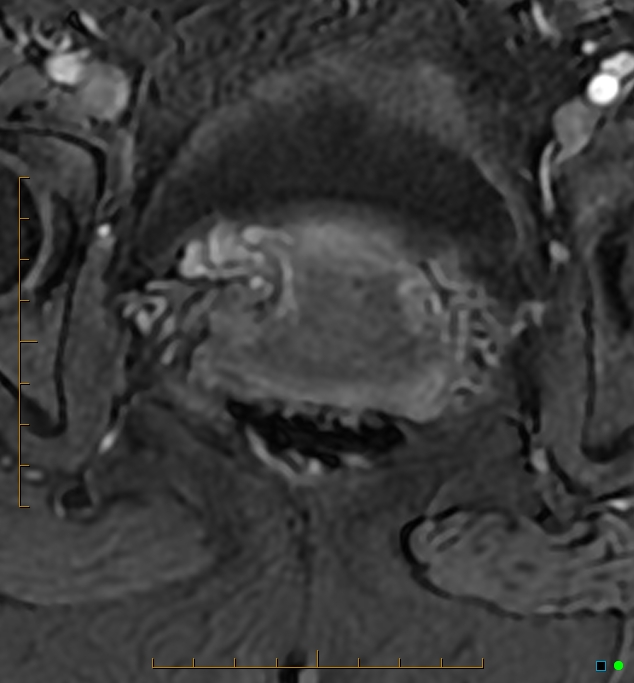 Adenomyosis uterus with hematometra (Radiopaedia 45779-50011 Axial T1 C+ fat sat 51).jpg