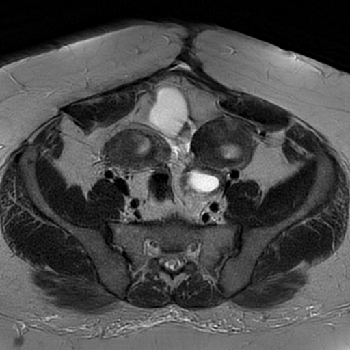 File:Adenomyosis within a didelphys uterus (Radiopaedia 70175-80215 Axial T2 11).jpg