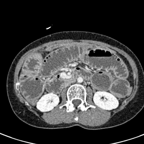 Adhesional small bowel obstruction (Radiopaedia 48397-53305 Axial C+ portal venous phase 33).jpg