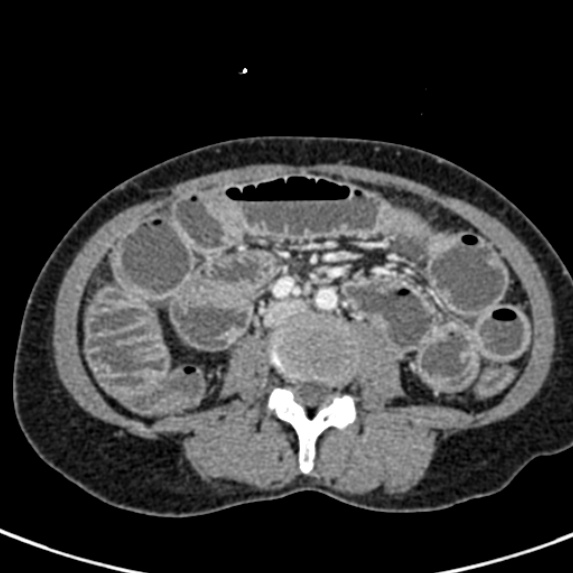 File:Adhesional small bowel obstruction (Radiopaedia 48397-53305 Axial C+ portal venous phase 46).jpg