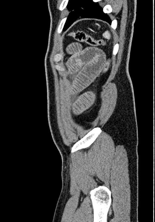 Adhesional small bowel obstruction (Radiopaedia 58900-66131 Sagittal C+ portal venous phase 226).jpg
