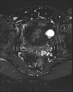 File:Adnexal multilocular cyst (O-RADS US 3- O-RADS MRI 3) (Radiopaedia 87426-103754 Axial T2 fat sat 16).jpg