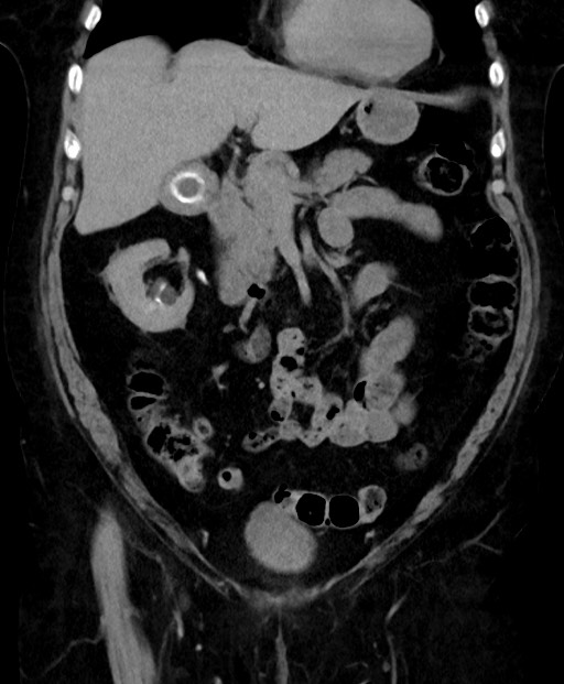 Adrenal cortical carcinoma (Radiopaedia 64017-72769 Coronal C+ delayed 25).jpg