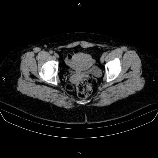 File:Adrenal cortical carcinoma (Radiopaedia 84882-100379 Axial non-contrast 89).jpg