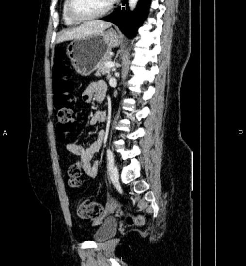 Adrenal cortical carcinoma (Radiopaedia 84882-100379 Sagittal C+ portal venous phase 54).jpg