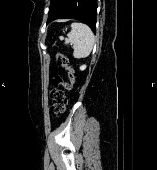 Adrenal cortical carcinoma (Radiopaedia 84882-100379 Sagittal C+ portal venous phase 75).jpg