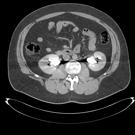 Adrenal cyst (Radiopaedia 45625-49778 AXIAL THICK 15 min 44).png