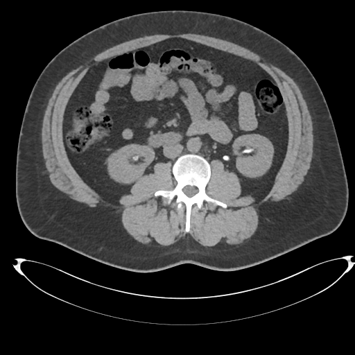 File:Adrenal cyst (Radiopaedia 45625-49778 Axial non-contrast 62).png