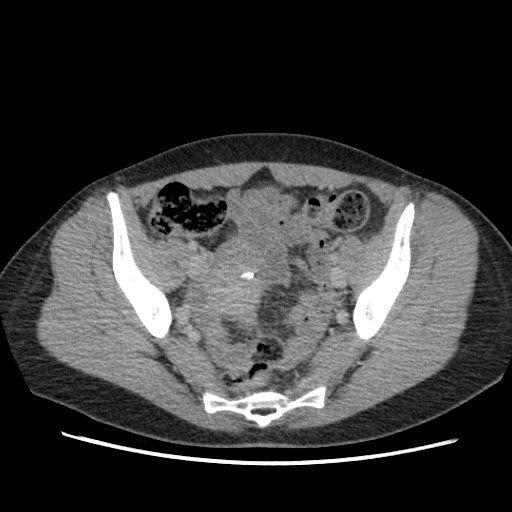 Adrenal cyst (Radiopaedia 64869-73813 Axial C+ portal venous phase 65).jpg
