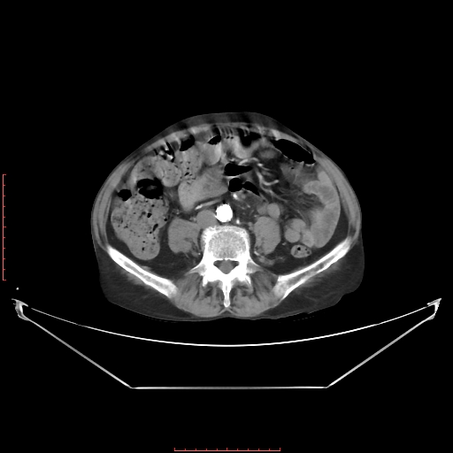 Adrenal hemangioma (Radiopaedia 68923-78668 Axial C+ arterial phase 47).jpg