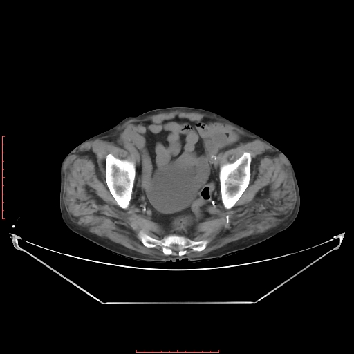 File:Adrenal hemangioma (Radiopaedia 68923-78668 Axial non-contrast 61).jpg