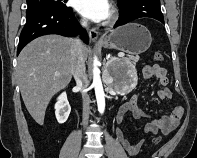 Adrenal metastases (Radiopaedia 73082-83791 Coronal C+ arterial phase 26).jpg