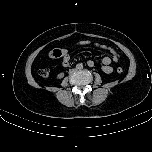 Adrenal myelolipoma (Radiopaedia 82742-96986 Axial non-contrast 96).jpg