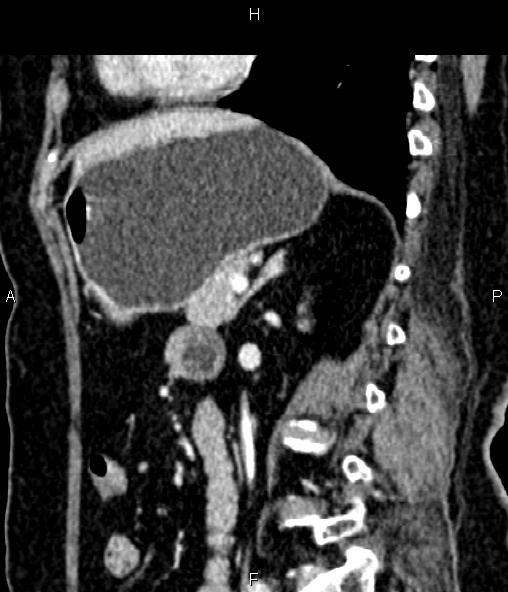 Adrenal myelolipoma (Radiopaedia 82742-96986 Sagittal renal cortical phase 68).jpg