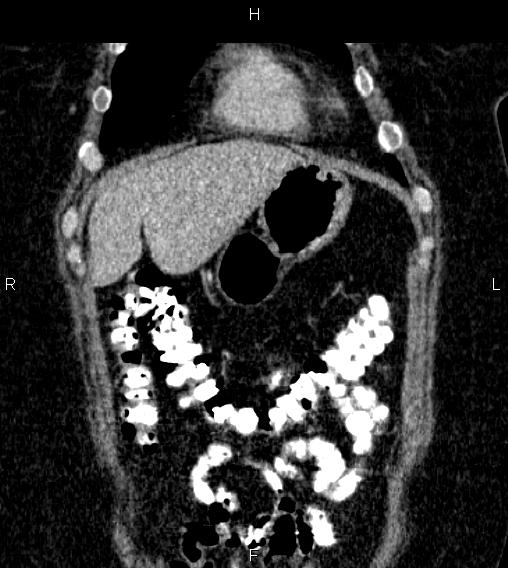 Adrenal myelolipoma (Radiopaedia 84319-99617 Coronal renal cortical phase 13).jpg