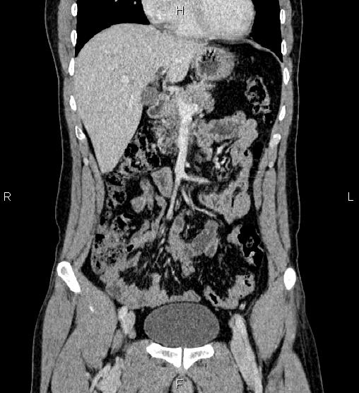 Adrenal myelolipoma (Radiopaedia 87794-104246 Coronal renal cortical phase 21).jpg