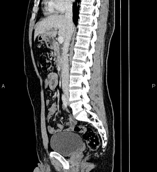 Adrenal myelolipoma (Radiopaedia 87794-104246 Sagittal renal cortical phase 43).jpg