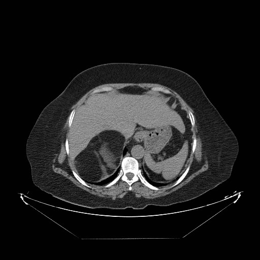 File:Adrenal myelolipoma (huge) (Radiopaedia 20368).jpg