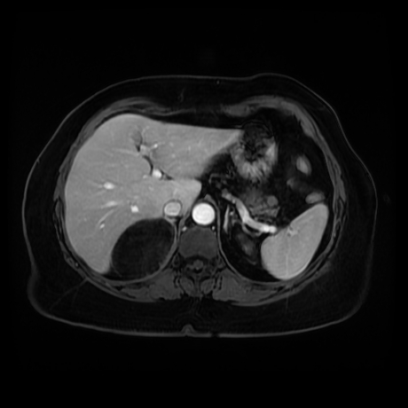 Adrenal myelolipoma - MRI (Radiopaedia 83249-97646 T1 fat sat arterial phase 22).jpg
