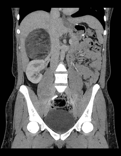 Adrenal myelolipoma - bilateral (Radiopaedia 74805-85810 Coronal C+ portal venous phase 157).jpg