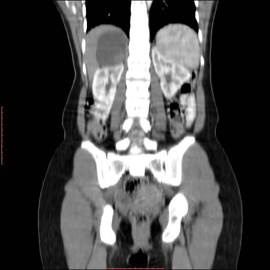File:Adrenal pseudocyst (Radiopaedia 44419-48073 Coronal C+ portal venous phase 9).jpg