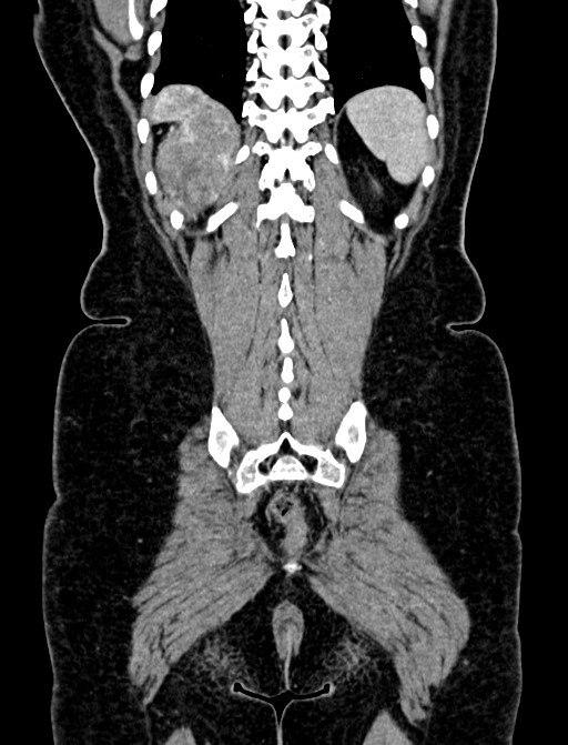 Adrenocortical carcinoma (Radiopaedia 87281-103569 Coronal C+ portal venous phase 130).jpg