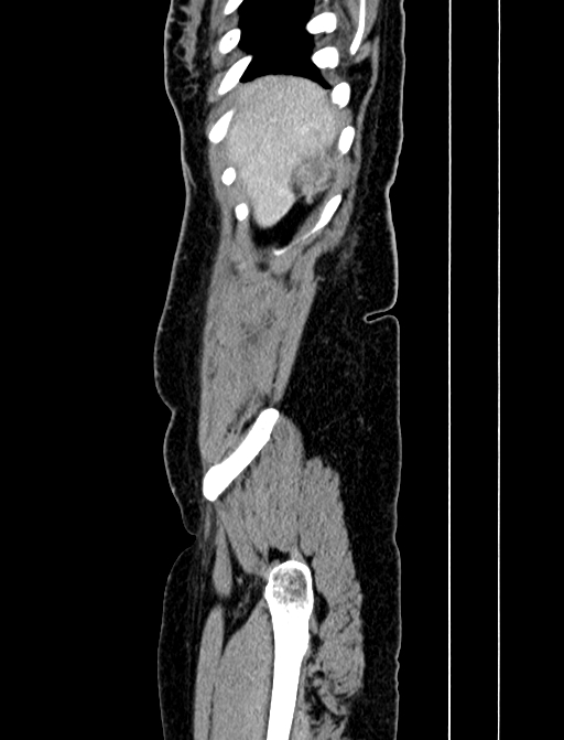 Adrenocortical carcinoma (Radiopaedia 87281-103569 Sagittal C+ portal venous phase 9).jpg
