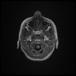 Adrenoleukodystrophy (Radiopaedia 60905-68711 Axial T1 5).jpg