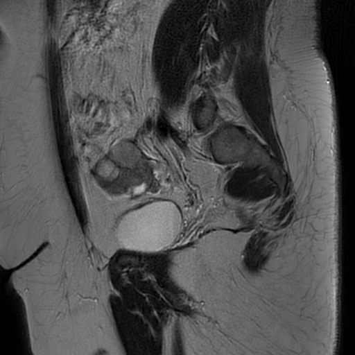 File:Adult granulosa cell tumor of the ovary (Radiopaedia 64991-73953 Sagittal T2 10).jpg