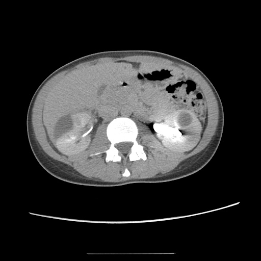 File:Adult polycystic kidney disease (Radiopaedia 48845-53876 Axial renal excretory phase 42).jpg