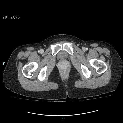 Adult transient intestinal intussusception (Radiopaedia 34853-36310 Axial C+ portal venous phase 125).jpg