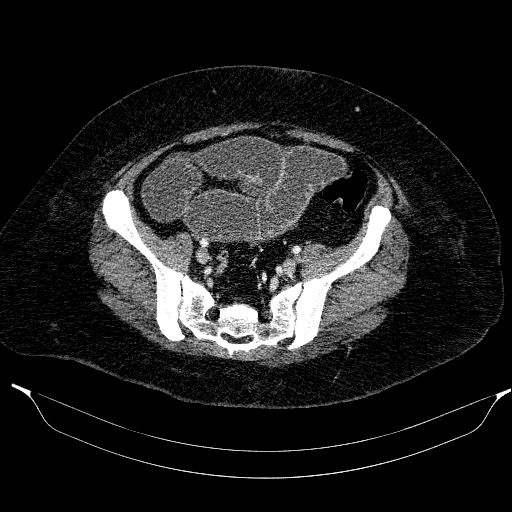 Afferent loop syndrome - secondary to incarcerated trocar site hernia (Radiopaedia 82959-97305 Axial C+ portal venous phase 182).jpg