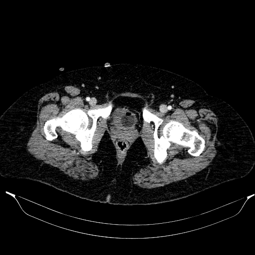 Afferent loop syndrome - secondary to incarcerated trocar site hernia (Radiopaedia 82959-97305 Axial C+ portal venous phase 231).jpg