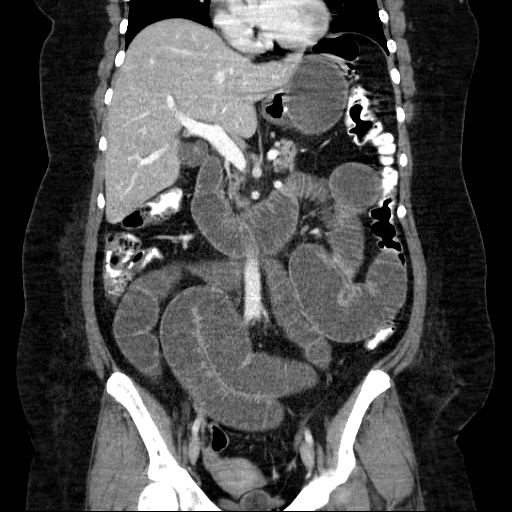 File:Afferent loop syndrome - secondary to incarcerated trocar site hernia (Radiopaedia 82959-97305 Coronal C+ portal venous phase 80).jpg