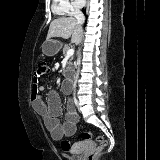 Afferent loop syndrome - secondary to incarcerated trocar site hernia (Radiopaedia 82959-97305 Sagittal C+ portal venous phase 80).jpg