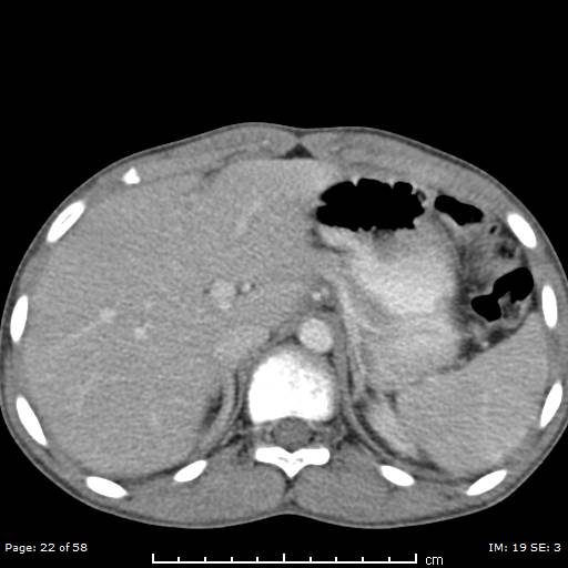 Agenesis of the gallbladder (Radiopaedia 55454-61905 B 22).jpg