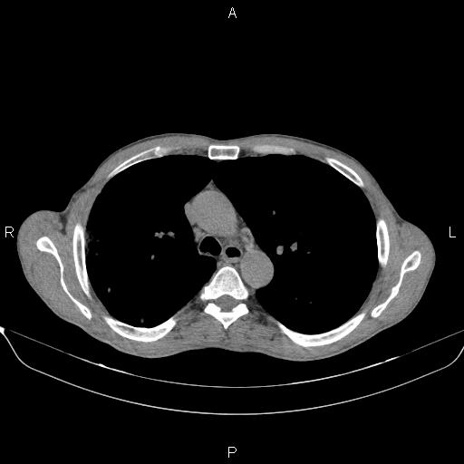 Air bronchogram in pneumonia (Radiopaedia 85719-101512 Axial non-contrast 24).jpg