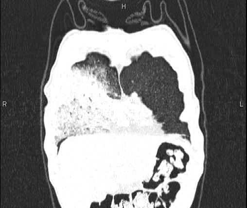 File:Air bronchogram in pneumonia (Radiopaedia 85719-101512 Coronal lung window 7).jpg