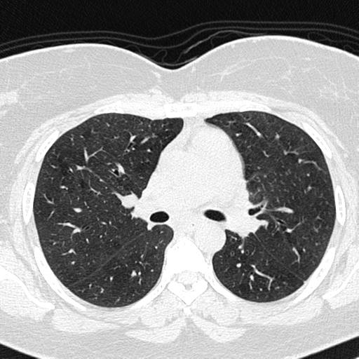 Air trapping in small airway disease (Radiopaedia 61685-69694 Axial lung window 74).jpg